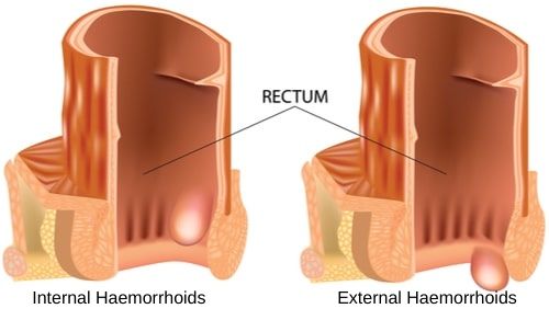 Do I Have Piles? How To Ease The Symptoms internal external haemorrhoids